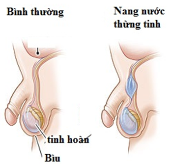 7. Các Biến Chứng Có Thể Gặp Khi Nang Nước Phát Triển Lớn