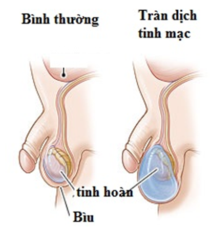 Khái Niệm Tràn Dịch Tinh Mạc