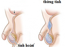 NANG NƯỚC THỪNG TINH Ở TRẺ NHỎ nntt
