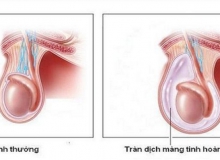 Tràn dịch màng tinh hoàn và cách điều trị hiệu quả tran dich mang tinh hoan