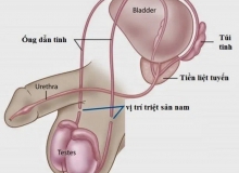 Một số điều cần biết khi triệt sản nam triet san nam